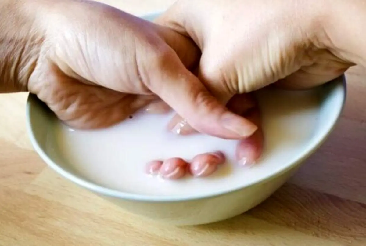 چگونه سوختگی را در خانه درمان کنیم؟