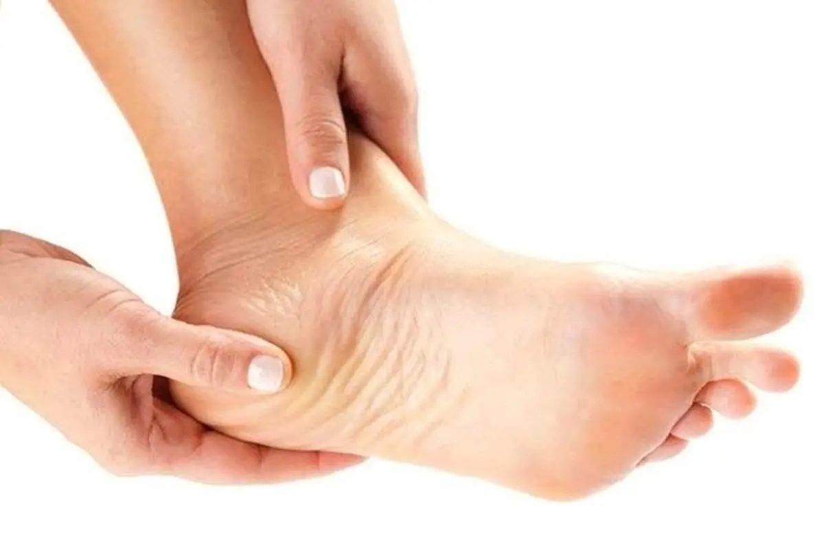 علت و علائم خارپاشنه چیست؟ + درمان خارپاشنه با طب سنتی