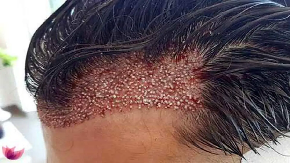 جراحی کاشت مو، کار دست این مرد کچل داد! + عکس