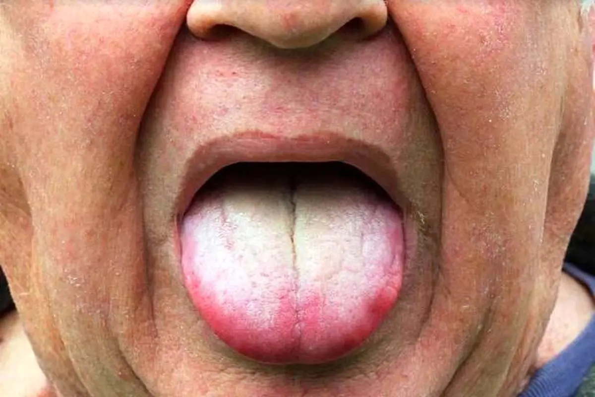 سفید شدن زبان زنگ خطر این بیماری‌هاست!
