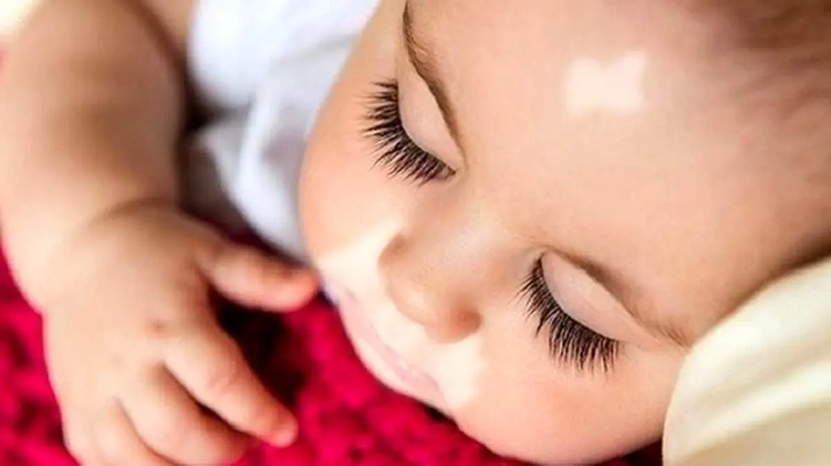 بیماری پیسی چیست و آیا درمان دارد؟