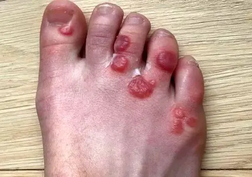 گیاهی که جای زخم را ترمیم می کند!