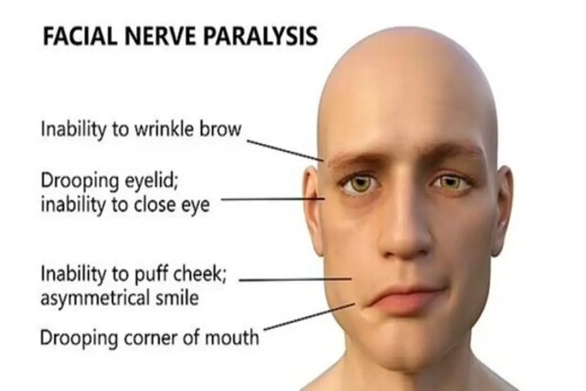 افزایش فلج صورت در بین مبتلایان به کرونا