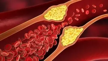 کاهش چربی خون + راهکار‌ها