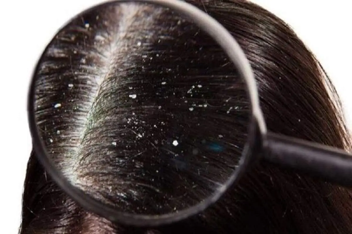 ارتباط شوره سر با مشکلات کبدی!