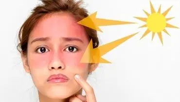 خطرات آفتاب سوختگی چیست؟ + روش های درمان