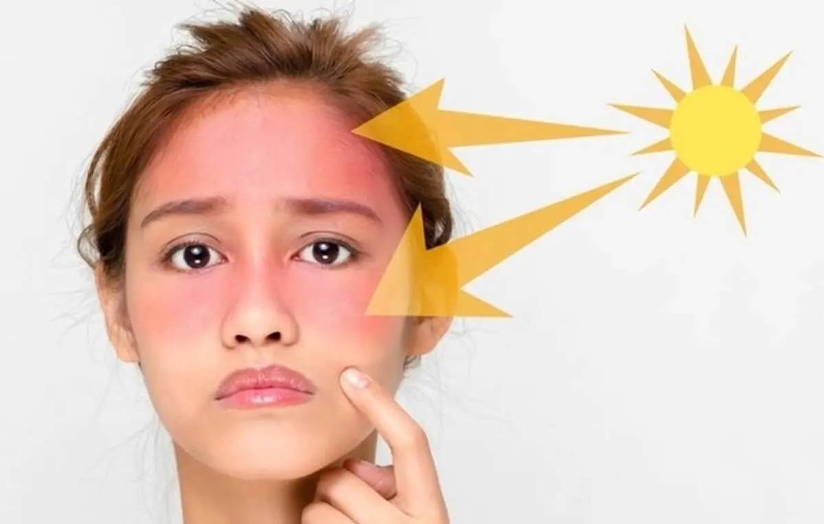 خطرات آفتاب سوختگی چیست؟ + روش های درمان