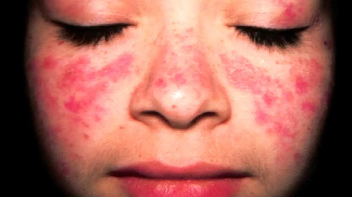 بیماری پوستی که سبب کاهش عمر می‌شود