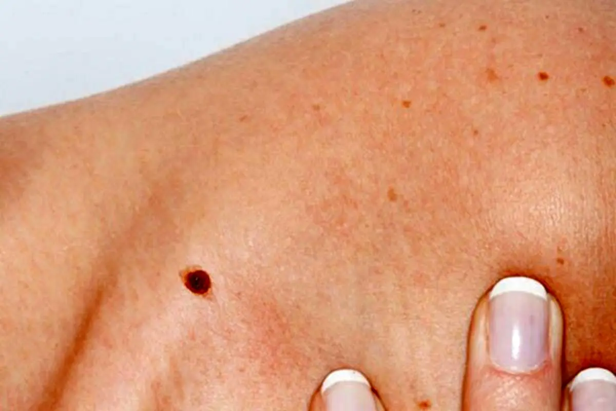 هر آنچه باید درباره سرطان پوستی ملانوم بدانید