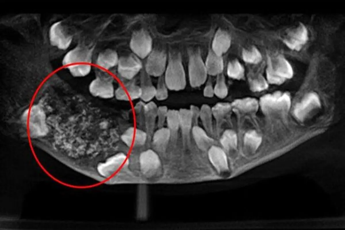 این پسر بچه ۸۰ دندان دارد + عکس
