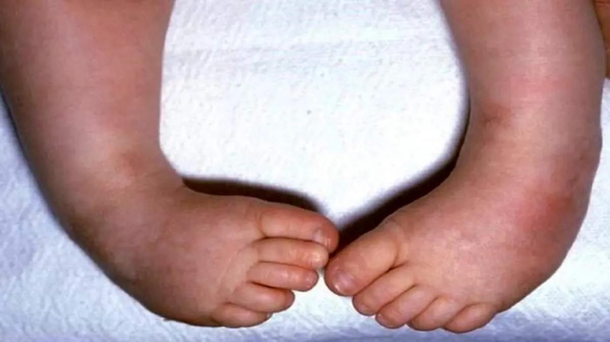 خطرات کمبود ویتامین D در کودکان