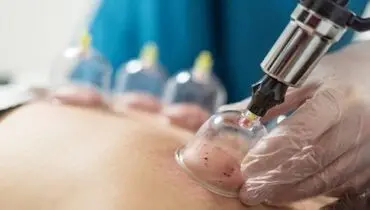 نقش حجامت در تضمین سلامتی