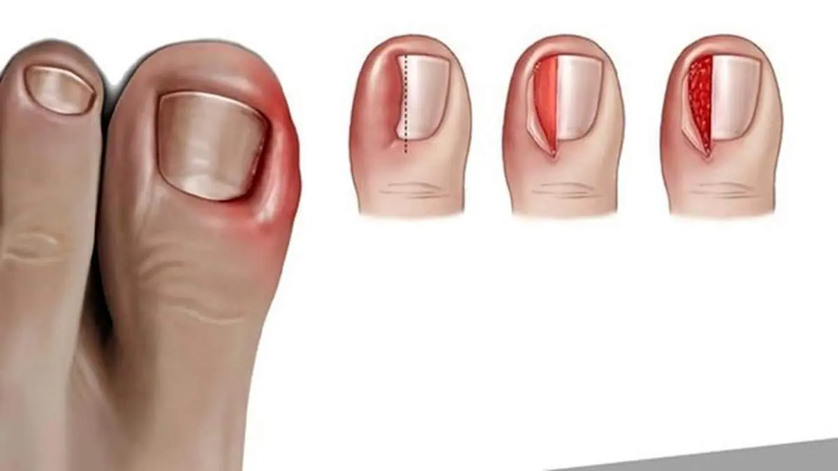 چگونه از رشد ناخن در گوشت پا جلوگیری کنیم؟