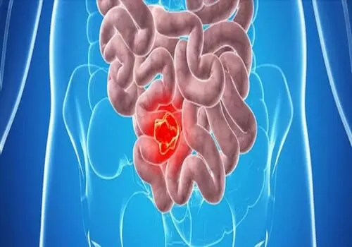 افزایش خطر ابتلا به سرطان روده با این رژیم‌غذایی 