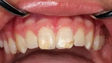 از دست‌دادن دندان‌ها و خطر ابتلا به آلزایمر و زوال عقل