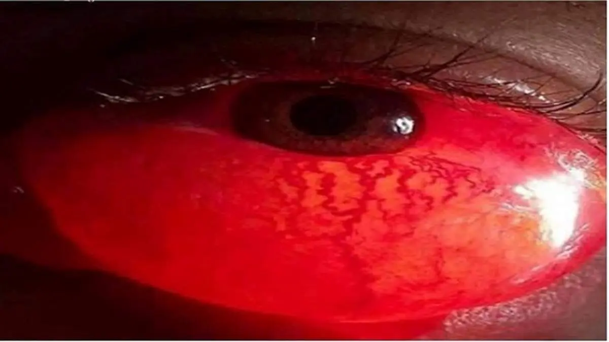 علل بیماری کموسیس چشمی چیست؟