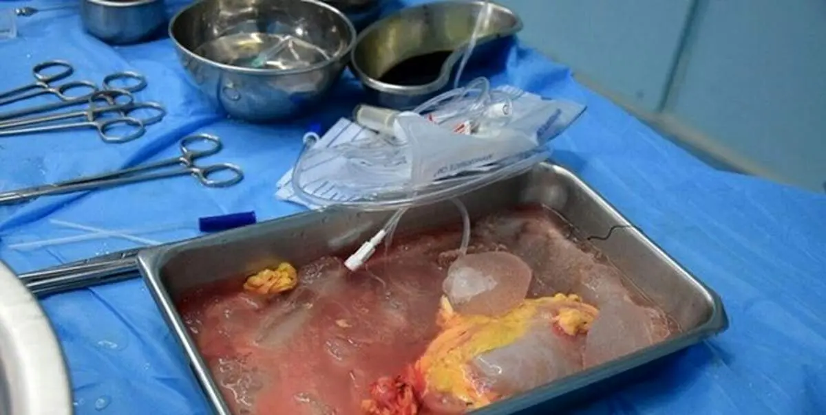 ششمین پیوند موفق کبد در تبریز انجام شد