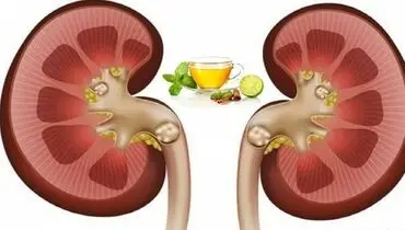 راهکار‌های طب سنتی برای درمان سنگ کلیه