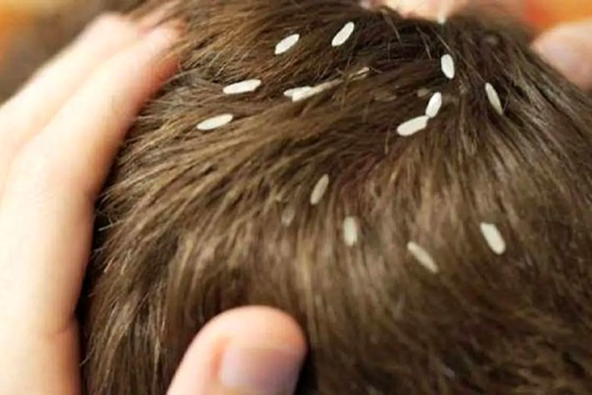 روش‌های درمان خانگی برای درمان شپش سر