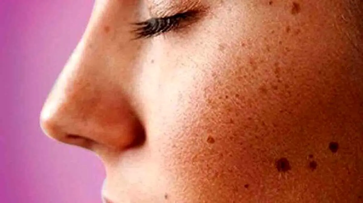چرا انسان روی پوستش خال دارد؟