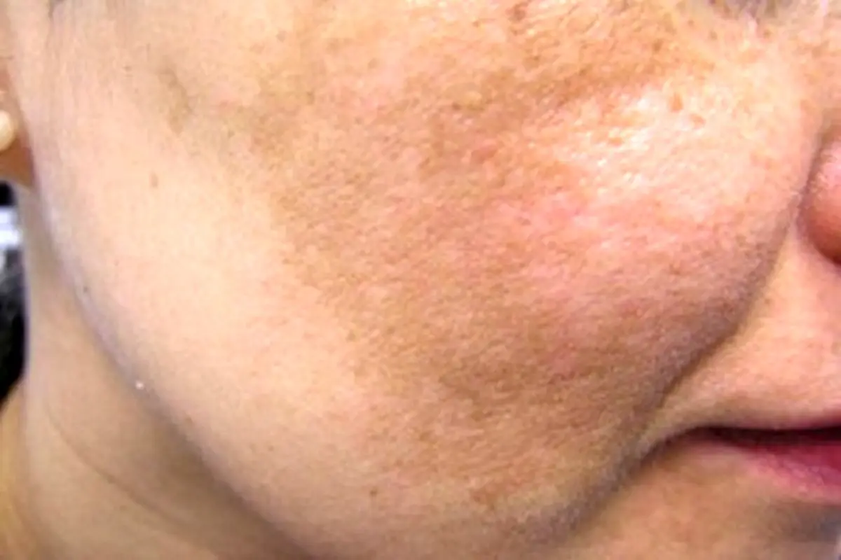 علل بروز لکه های پوستی چیست؟ + روش درمان