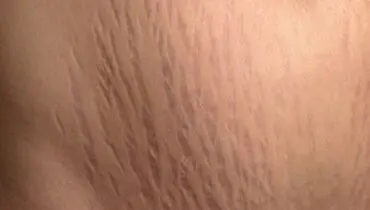 خوراکی های خطرناک که باعث سلولیت می‌شوند