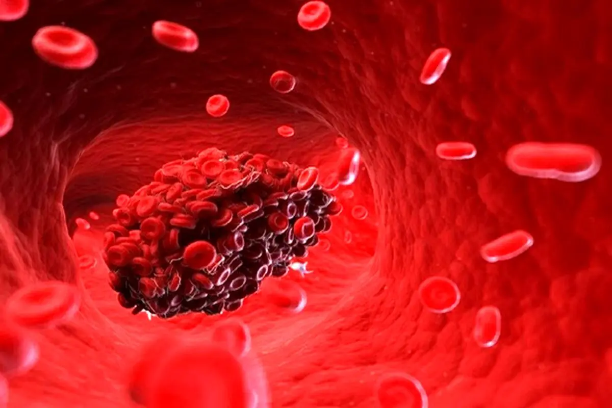 علائم اولیه و مهم لخته شدن خون چیست؟