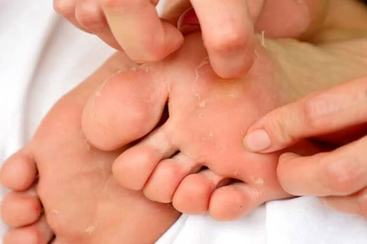 ۵ دلیل رایج پوسته پوسته شدن کف پا چیست؟