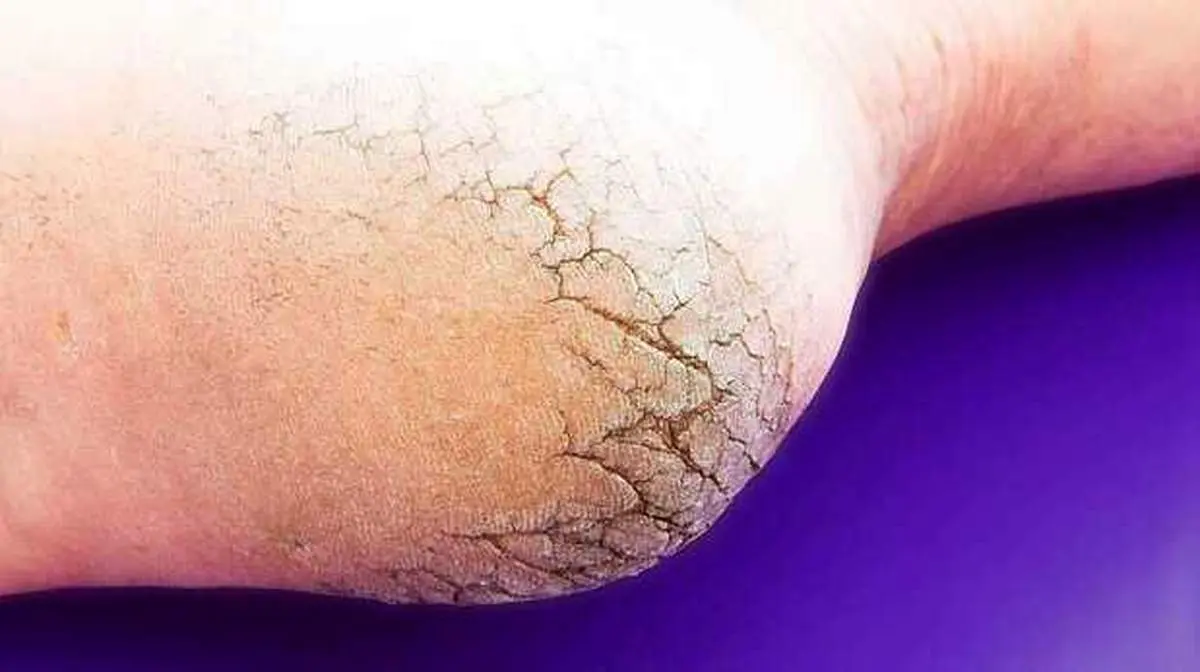 اصلی‌ترین دلایل بروز ترک پاشنه پا