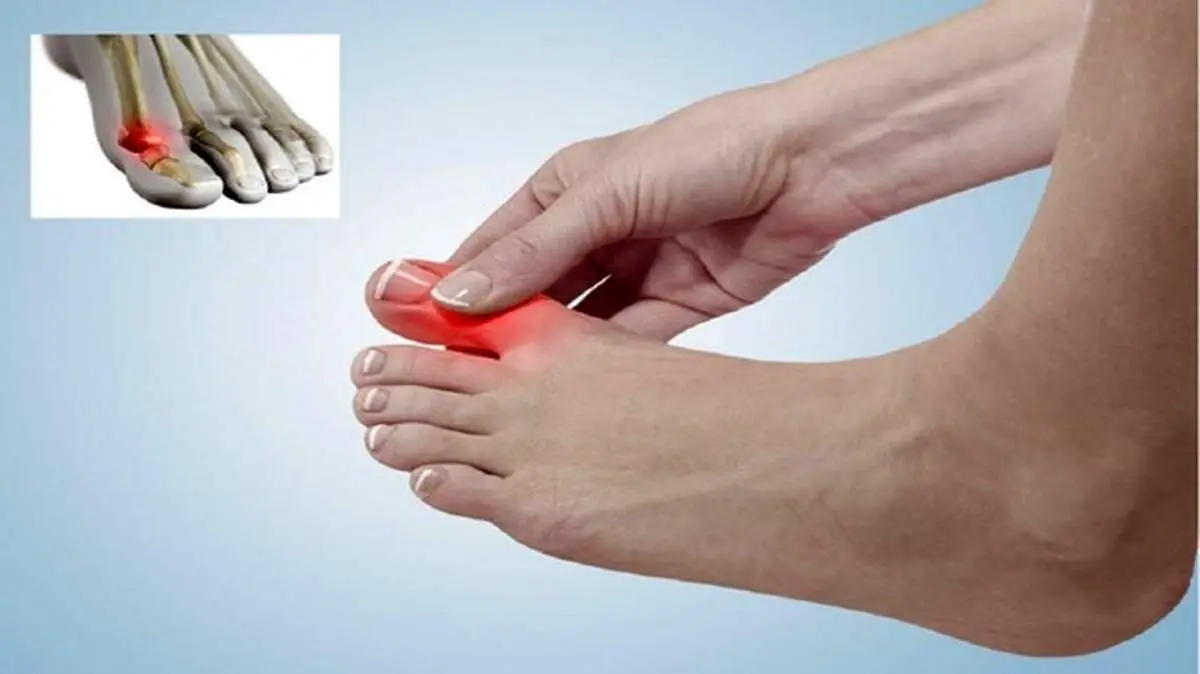 بیماریهایی که باعث درد در انگشت شست پا میشوند