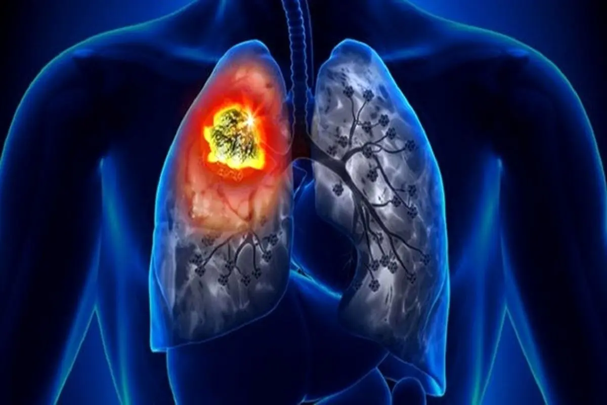 نشانه‌های اصلی سرطان ریه چیست؟