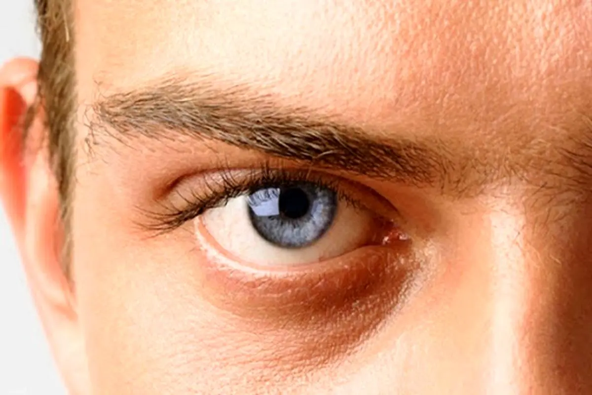 بیماری آب سیاه چشم چیست؟ +روش تشخیص و درمان