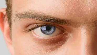 بیماری آب سیاه چشم چیست؟ +روش تشخیص و درمان