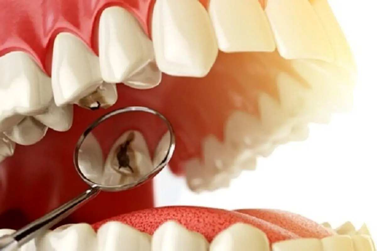 نامناسب بودن جنس دندان‌ ژنتیکی است؟