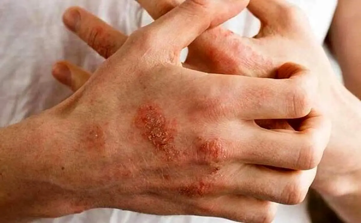 عجیب‌ترین نوع سرطان که در کف دست نمایان می‌شود
