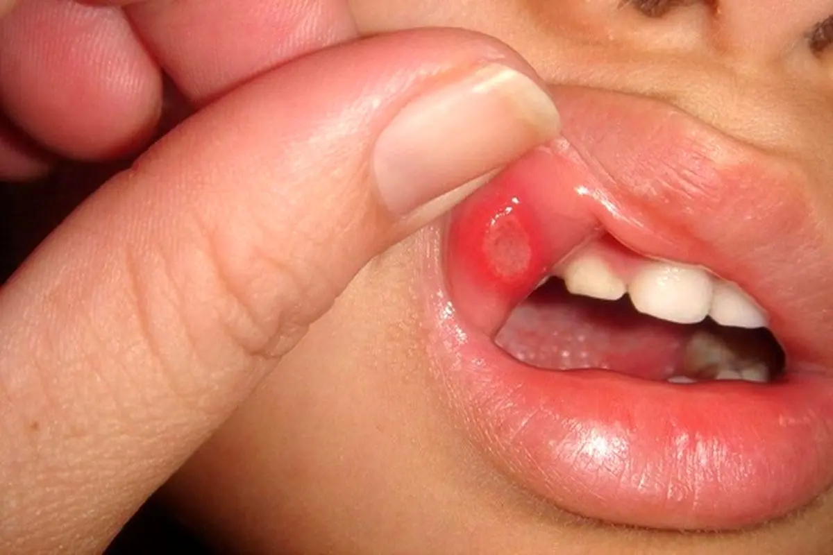 علل ایجاد آفت در دهان چیست؟