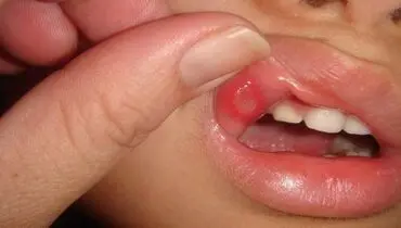 علل ایجاد آفت در دهان چیست؟