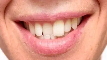 عوارض رعب آور تراکم و فشردگی دندان‌ها به یکدیگر