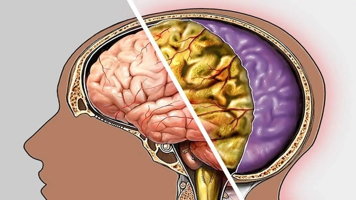 دردناکترین علائم مننژیت که نمیدانستید