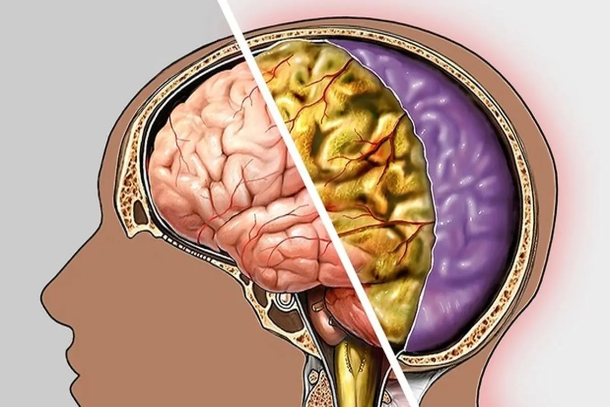 دردناکترین علائم مننژیت که نمی‌دانستید