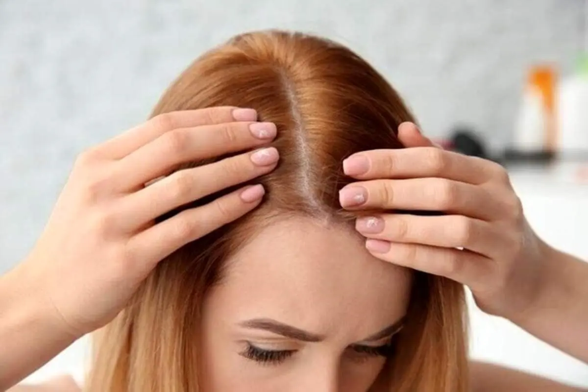 پیشگیری از ریزش موها با ۷ خوراکی خوشمزه