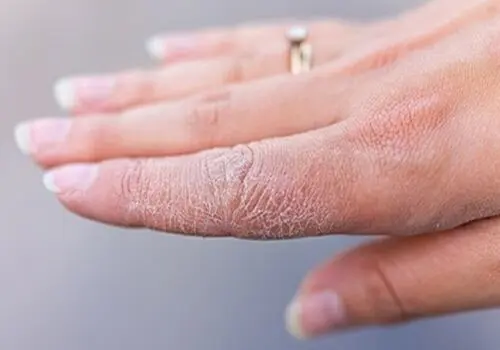 ۳ بیماری پوستی با علایم مشابه