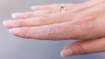 توصیه‌هایی برای پیشگیری از خشک شدن پوست
