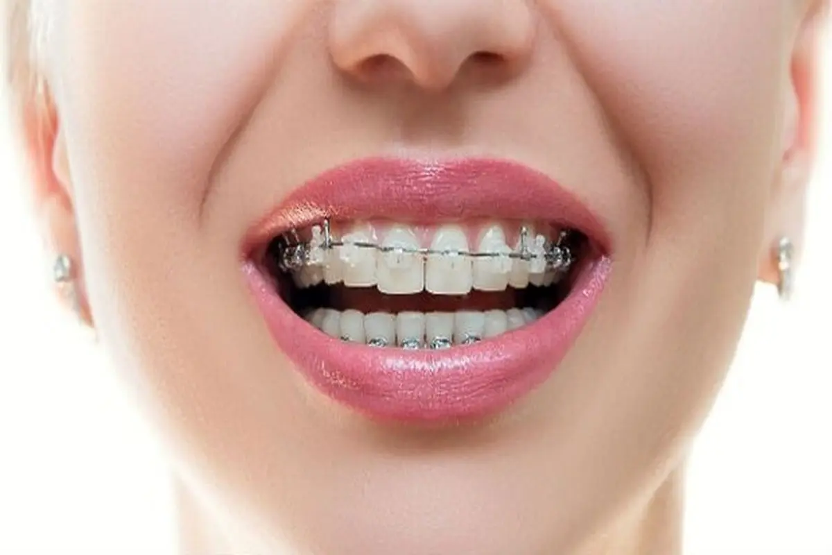 ارتودنسی چقدر در سلامت دندان تاثیرگذار است؟