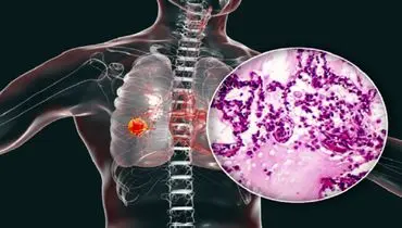 نشانه ها و علائم عجیب سرطان ریه چیست؟