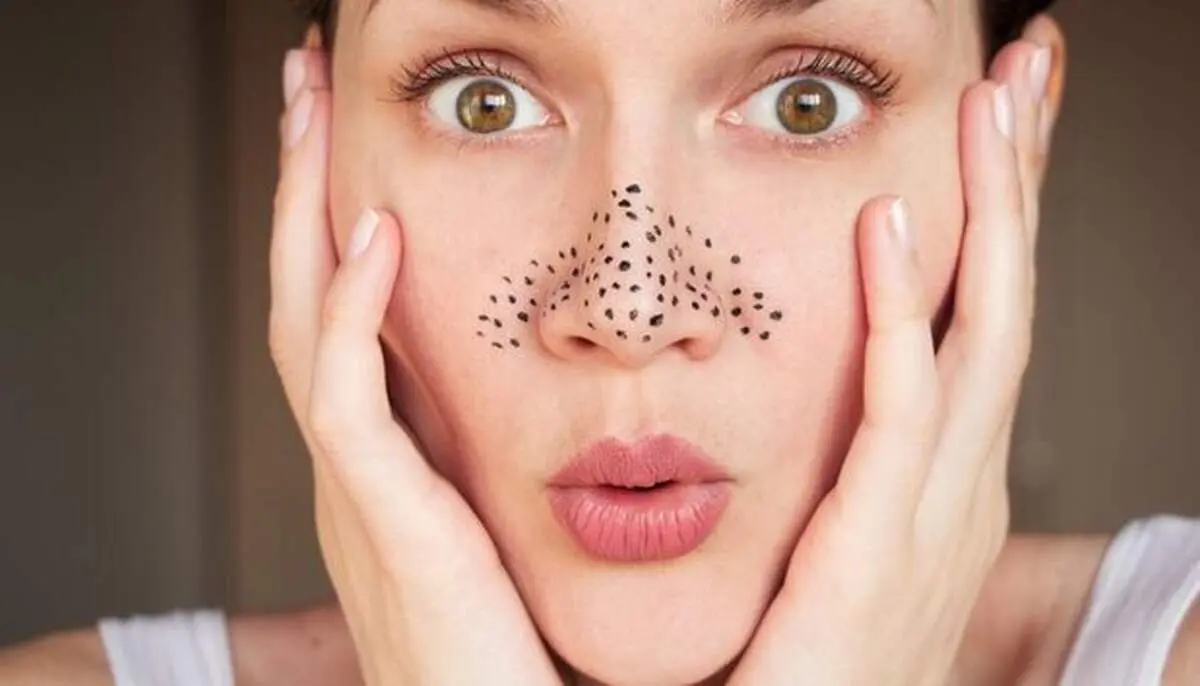 نکاتی برای از بین بردن جوش‌های سرسیاه