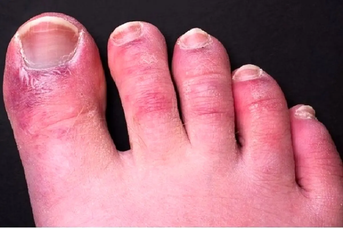 عارضه انگشت پای کوویدی چیست؟