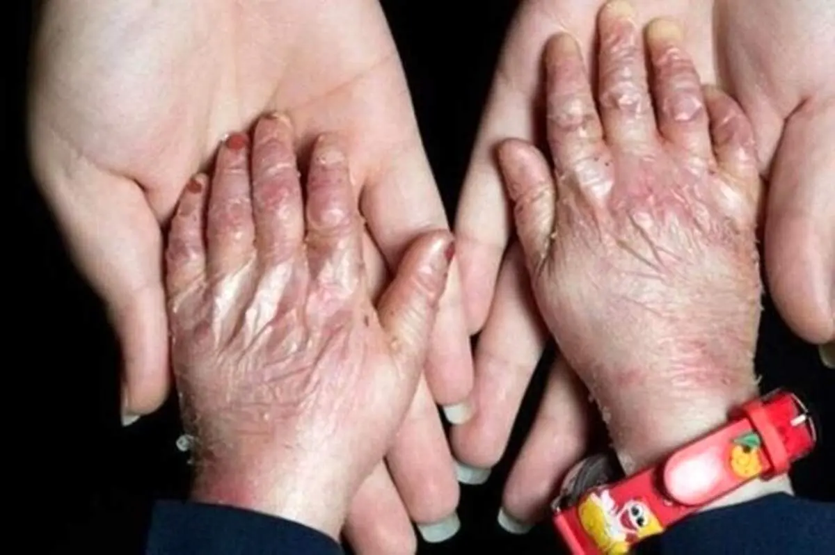 تکذیب مفقودی پانسمان بیماران پروانهای ”ای بی“