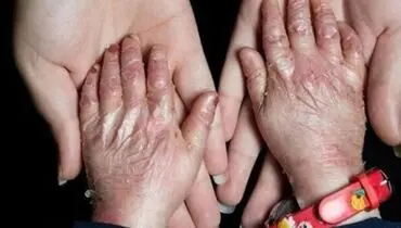 تکذیب مفقودی پانسمان بیماران پروانه‌ای ”ای بی“