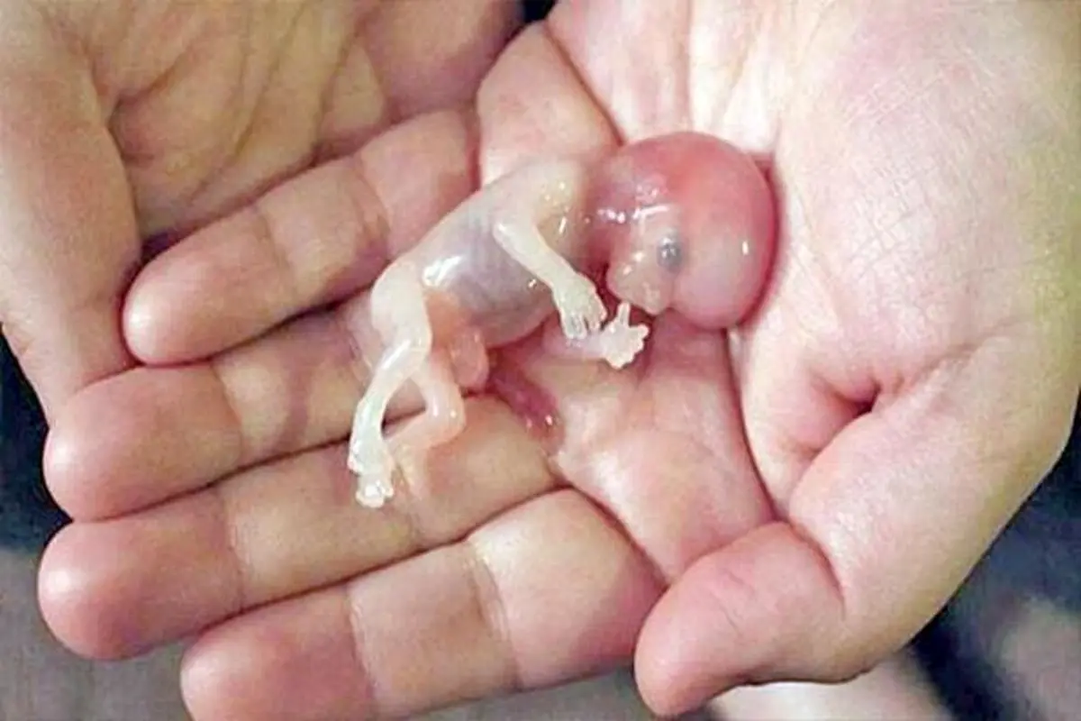 تصویر دردناک سقط جنین هفت هفته ای خارج از رحم